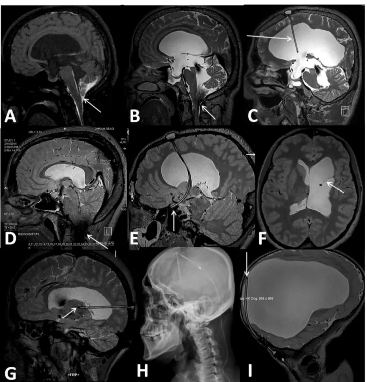 Fig. 6   Four different patients with VPS. Postcontrast MR cister- cister-nography image of a 34  year old male who presented with  rhinor-rhea, fourth ventricular outlet obstruction is seen (arrow, a)