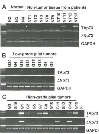 Figure 1. Differential expression of TAp73 and ANp73 in normal brain and  malignant gliomas