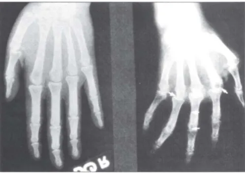 Figure 1.2 Radiographs of normal hand (left) and arthritic hand (right). (Arrows denote loss  of normal axial alignment) (Rhodes, 1991) 
