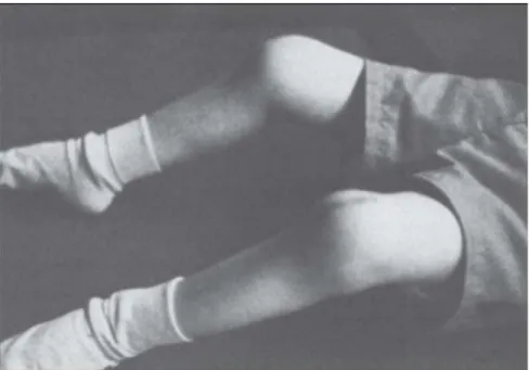 Figure 1.4.  Flexion contracture in child with juvenile idiopathic arthritis (Rhodes, 1991)