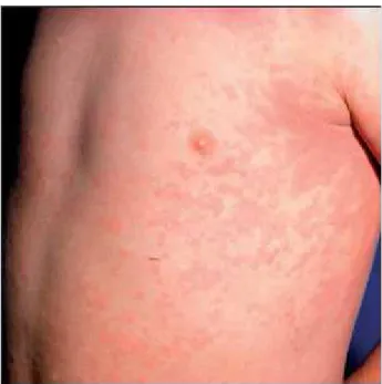 Figure 1.5 Typical rash of systemic-onset disease in an 8-year-old child (Ravelli et al., 2007)