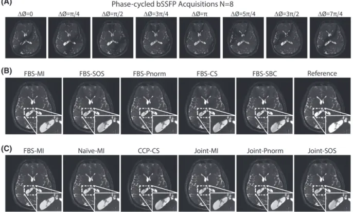 FIGURE 4 In vivo bSSFP acquisitions of the brain with D = 4 , N = 2 were reconstructed (Dataset #2)