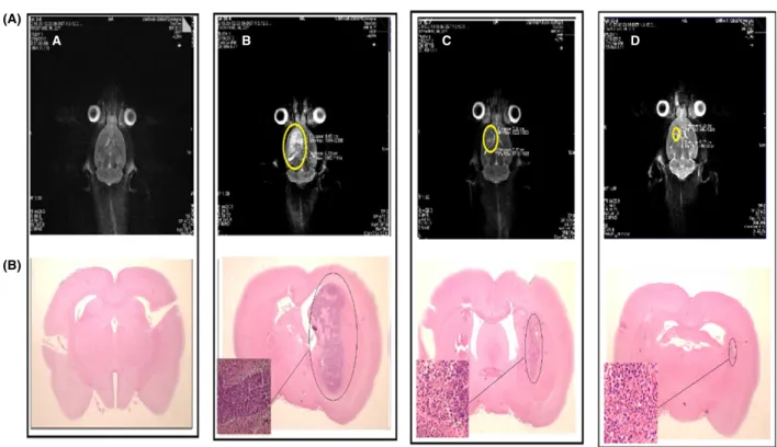 Figure 4 Samples of magnetic resonance images (A) and light microscopy images (B) (H&amp;E, 910) of pathology specimens, obtained from differ- differ-ent group of rats without brain tumour (a) with brain tumour (b) and after 5 days of intravenous injection