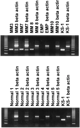 Figure 1 Detection of KSHV gene sequences in DNA isolated from bone marrow core biopsy of patients (upper lane: MM 3, 7, 8 and 10, and extramedullary plasmacytoma (EMP)), normal controls (lower lane) and as a positive control KS-1 cell line by DNA-PCR usin