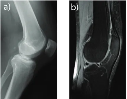 Figure 1.1: a) X-Ray and b) MRI images of knee [1] (used with permission).