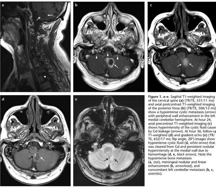 Figure 1. a–e. Sagittal T1-weighted imaging  of the cervical spine (a) (TR/TE, 531/11 ms)  and axial postcontrast T1-weighted imaging  of the posterior fossa (b) (TR/TE, 506/12 ms)  show a hypointense cystic metastasis (arrows)  with peripheral wall enhanc