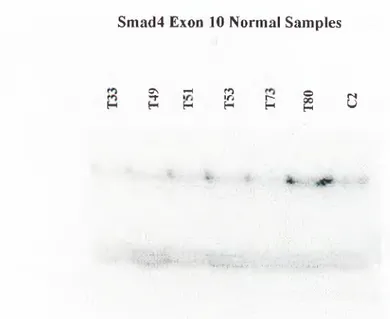 Figure 3.2:  SSCP Analysis of Exon  10 Tumor DNAs with  No Alteration