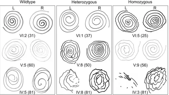 Figure 2.5 Archimedes spiral tests of individuals of various ages and genotypes at HTRA2  p.G399S