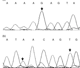 Fig. 3. (a) DNA sequence of patient 97/670 showing the BRCA1 allele with missense mutation 2080 A!G