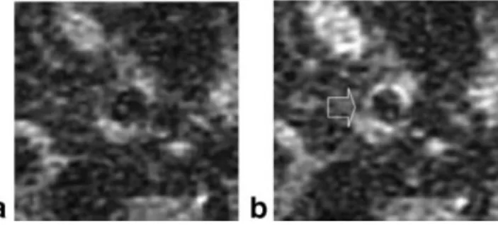 Figure 4. Surface coil– based MR images of the iliac artery of a pig, before (a) and three hours post-MGd injection (b)