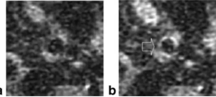Figure 4. Surface coil– based MR images of the iliac artery of a pig, before (a) and three hours post-MGd injection (b)