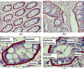 Fig. 1. Colon adenocarcinoma changes the morphology and composition of colon glands. This figure shows the gland boundaries on (a) normal and (b) cancerous tissue images