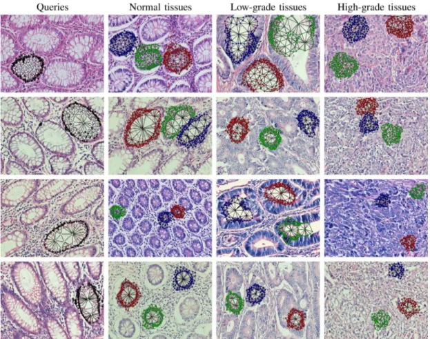Fig. 4. The query graphs generated as a reference for a normal gland structure and the subgraphs located in example normal, low-grade cancerous, and high-grade cancerous tissue images