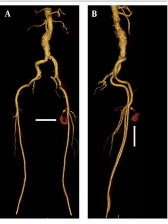 Figure 1. MDCTA maximum intensity projection (MIP) images. A) Ante- Ante-rior-posterior view B) Lateral view