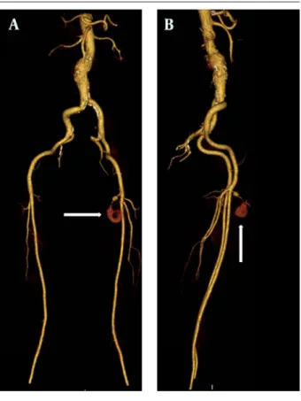 Figure 1. MDCTA maximum intensity projection (MIP) images. A) Ante- Ante-rior-posterior view B) Lateral view