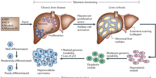 Figure  1.1:  Histopathological  progression  and  molecular  features  of  HCC.  After  hepatic  injury  incurred  by  any  one  of  several  factors  (HBV,  HCV,  alcohol  and  aflatoxin  B1),  there  is  necrosis followed by hepatocyte proliferation