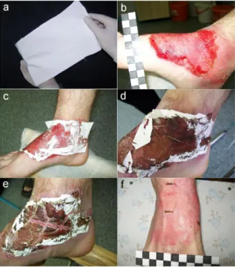 Fig. 6.8 Example of healing of IIIa burn: (A)sample of chitosan nanofiber dressing, (B) IIIa burn before covering, (C) after covering, (D) 5 days after covering, (E) 10 days after covering, and (F) 14 days after covering.