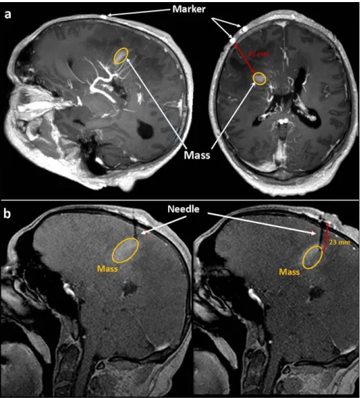 FIG. 9. Clinical feasibility of biopsy needle guidance using the resonator markers under a 3T MRI scanner