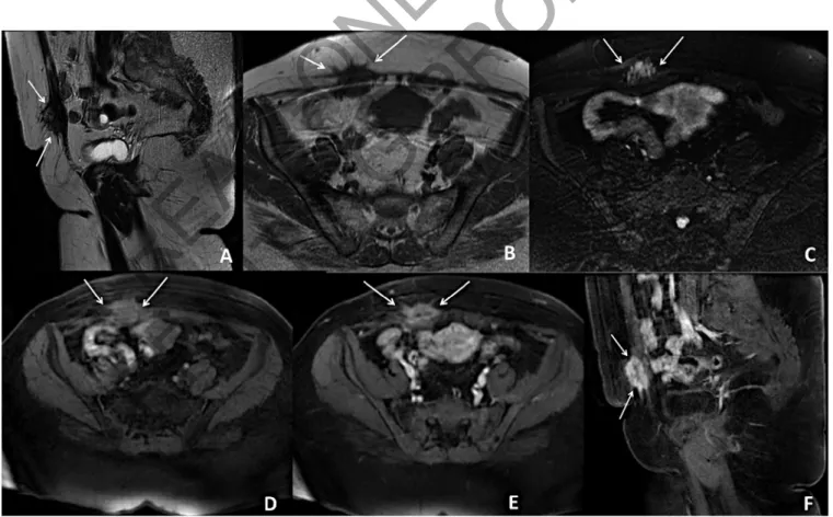 Fig. 1: 45-year-old-patient with cesarean section history 11 years ago. There is a 26x18x32 mm hypointense mass (arrows) above the right rectus abdominis muscle on the sagittal T2 weighted image (A)