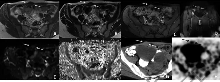 Fig. 2: 35-year-old patient presented with complaints of abdominal pain. On T1 weighted image a 21x11x17 mm isointense mass is locat- locat-ed at right rectus abdominis muscle (arrows) (A)