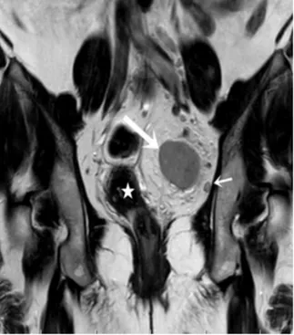 Fig. 1. MRI examination. A solid mass (white arrow) at the left of the pelvis is detected in a T1 weighted coronal MR image