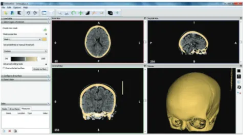 Figure 2: Skull stripping in InVesalius medical image program.