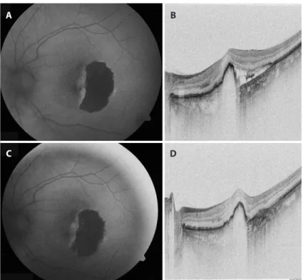 Figure 2. A) The initial fundus autofluorescent imaging of the RPE tear with two disc-sized hypoauto- hypoauto-fluorescent areas