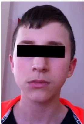 Figure  1.  Angioedema  after  oral  food  challenge  test  with  sage tea. The patient who had developed angioedema after  eating  chicken  with  cheddar  cheese;  however,  oral  food  challenge  with  both  cheddar  cheese  and  chicken  was  negative