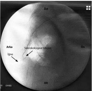 Şekil 1.  İğnenin sakrokoksigeal bileşkeden uygulanmasının la- la-teral fluoroskopi görüntüsü.
