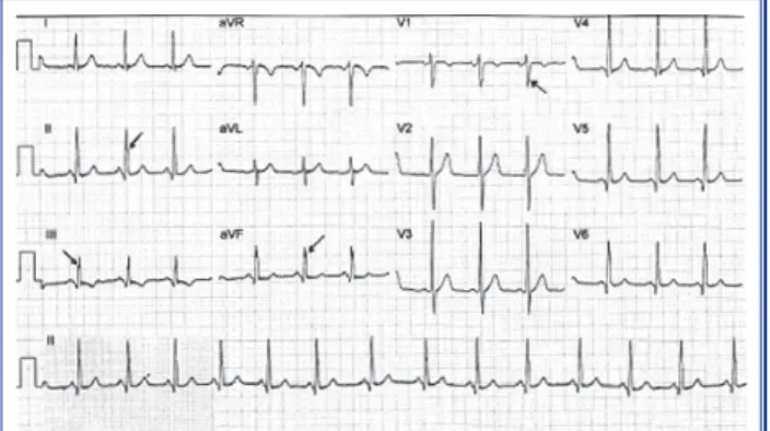 Figure  1.  12-lead  ECG  from  a  hypertensive  patient  with  Grade  2  diastolic  dysfunction  showing  fragmented  QRS  complexes in leads II, III, aVF, and V1 (arrow heads).