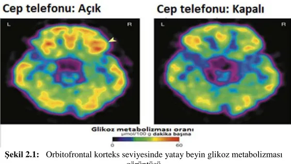 ġekil 2.1:  Orbitofrontal korteks seviyesinde yatay beyin glikoz metabolizması  görüntüsü 