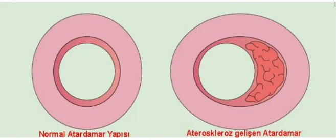 ġekil 1.5  Normal ve ateroskleroz geliĢmiĢ atardamar yapısı [50]. 