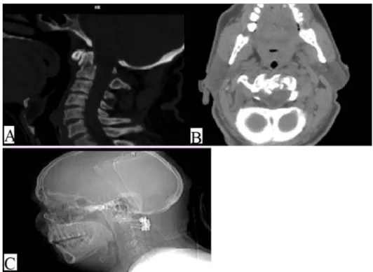 Figure 1: A-B Preoperative CT scan of case 4. C Post operative control cervical radiographs