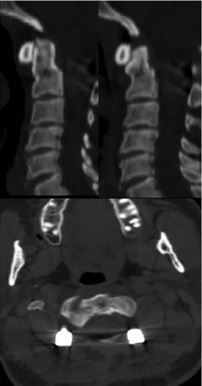 Figure 3: Post opretive CT scan of case 4 at sixth month. 