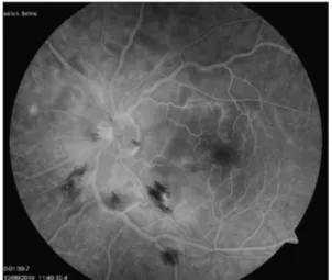 FIGURE 1: Color fundus photo reveals cotton wool spots and retinal hemor- hemor-rhages at the posterior pole which are seen as hypo-fluorescent in  angio-graphic images.