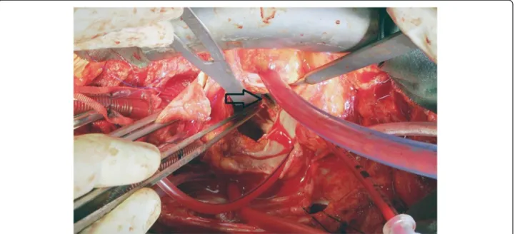 Figure 2 Perioperative image of paravalvular leak area. Arrow indicates paravalvular leakage area.