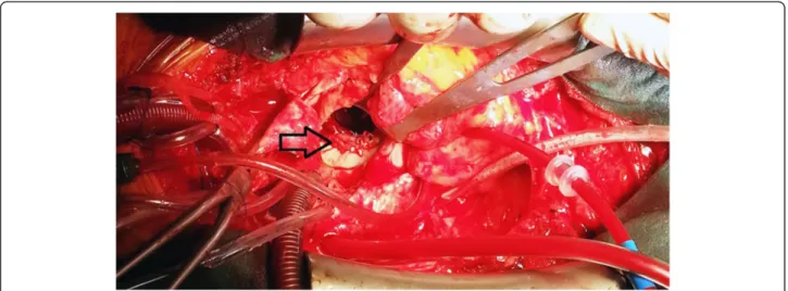 Figure 3 Periopertive image of repaired paravalvular leak area. Arrow indicates repaired paravalvular leakage.