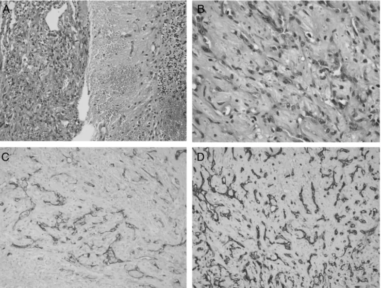 Figure 2.  A) Tumor showing angiosarcoma morphology; it is uniformly separated from the cerebellum, B) Pleomorphic tumor cells having distinctive  giant nucleoli, C) Immunohistochemistry positive for CD34 in the tumor cells, D) Immunohistochemistry positiv