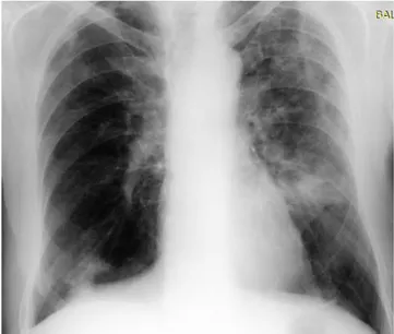 Şekil 1: Başvuru sırasındaki PA akciğer grafisi. 