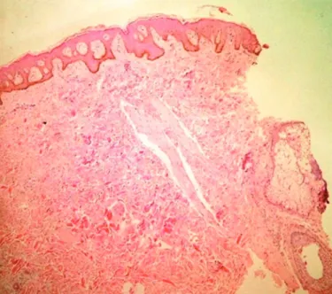 Figure  1.  A  brownish  patchy  adjacent  to  the  depigmented  patch  lesion on the upper back portion of the trunk at the midline
