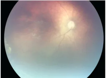 Figure 4. Fundus view of the same patient 3 months after laser photocoagulation.