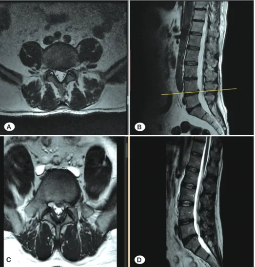 Figure 1: Paramedian lumbar disc  herniations. A) Axial, and B) sagittal  T2W MRI scans of L4-5  disc herniation
