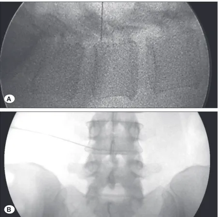Figure 2: Lumbar transforaminal epidural steroid  injection under C-arm guidance. A) Lateral view,          B) anteroposterior view.