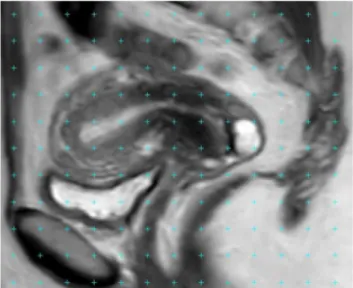 Fig. 1.A sagittal MRI with a point-counting grid superimposed on it for the estimation of volume of uterine layers.