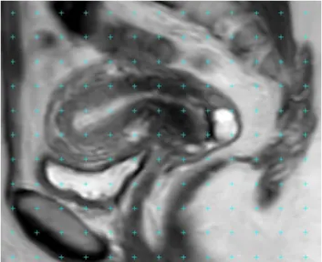 Fig. 1.A sagittal MRI with a point-counting grid superimposed on it for the estimation of volume of uterine layers.