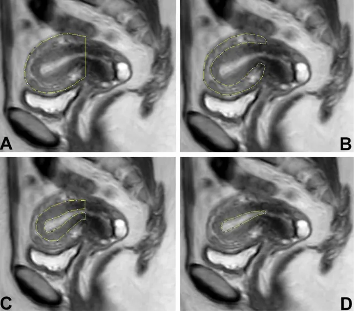 Fig. 2. A sagittal MRI with a planimetric contour on it for the estimation of volume of total uterus (a), outer myometrium (b), junctional zone (c) and endometrium (d).