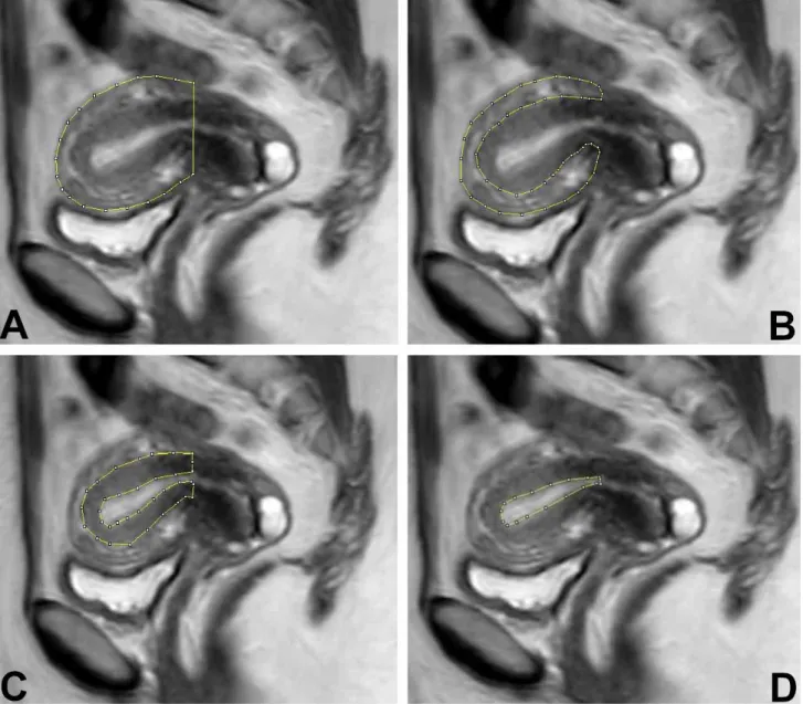 Fig. 2. A sagittal MRI with a planimetric contour on it for the estimation of volume of total uterus (a), outer myometrium (b), junctional zone (c) and endometrium (d).