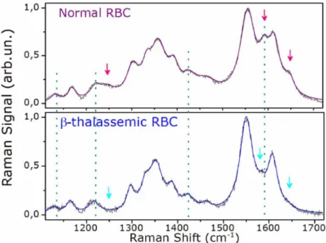 Figure 1.9: Raman spectra of red blood cells that are optically trapped. The spectra of normal and β-thalassemic RBCs are compared