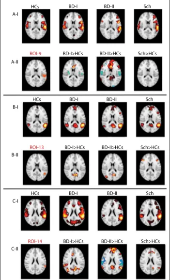 Figure 2: Group-level connectivity maps by using (A) left  supramarginal gyrus (ROI-9; Brodmann 40), (B) medial left  superior temporal sulcus (ROI-13; Brodmann 41, 42) and (C)  lateral left superior temporal gyrus (ROI-14; Brodmann 21, 22)  as seeds