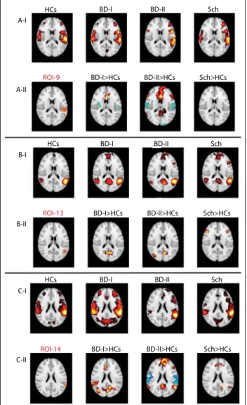 Figure 2: Group-level connectivity maps by using (A) left  supramarginal gyrus (ROI-9; Brodmann 40), (B) medial left  superior temporal sulcus (ROI-13; Brodmann 41, 42) and (C)  lateral left superior temporal gyrus (ROI-14; Brodmann 21, 22)  as seeds